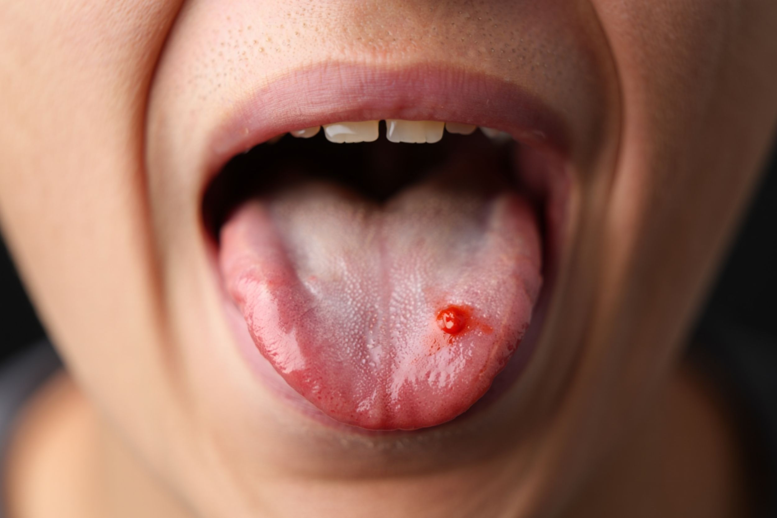 Femme avec un bouton sur la langue