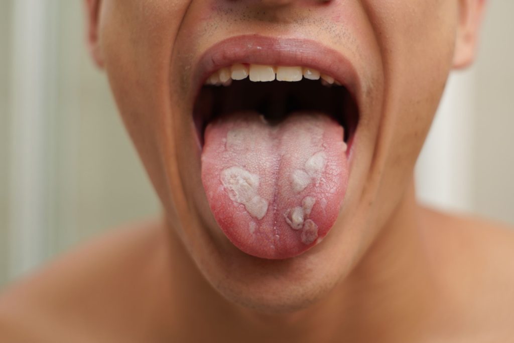 Photo d'une candidose linguale