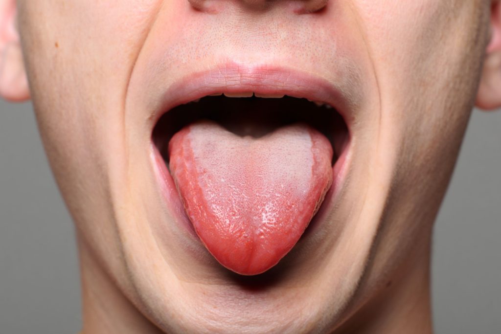 Photo d'une glossite aiguë