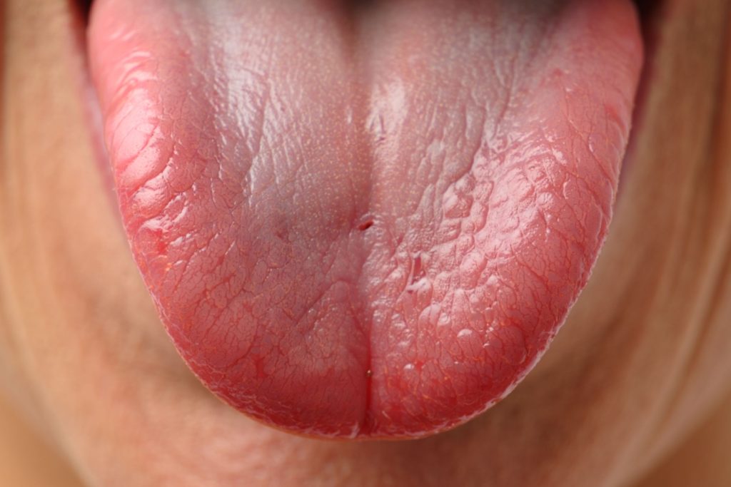 Photo d'une glossite de hunter