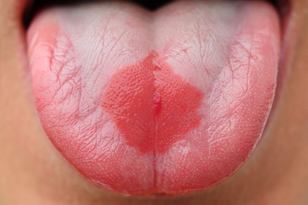 Photo d'une glossite losangique médiane
