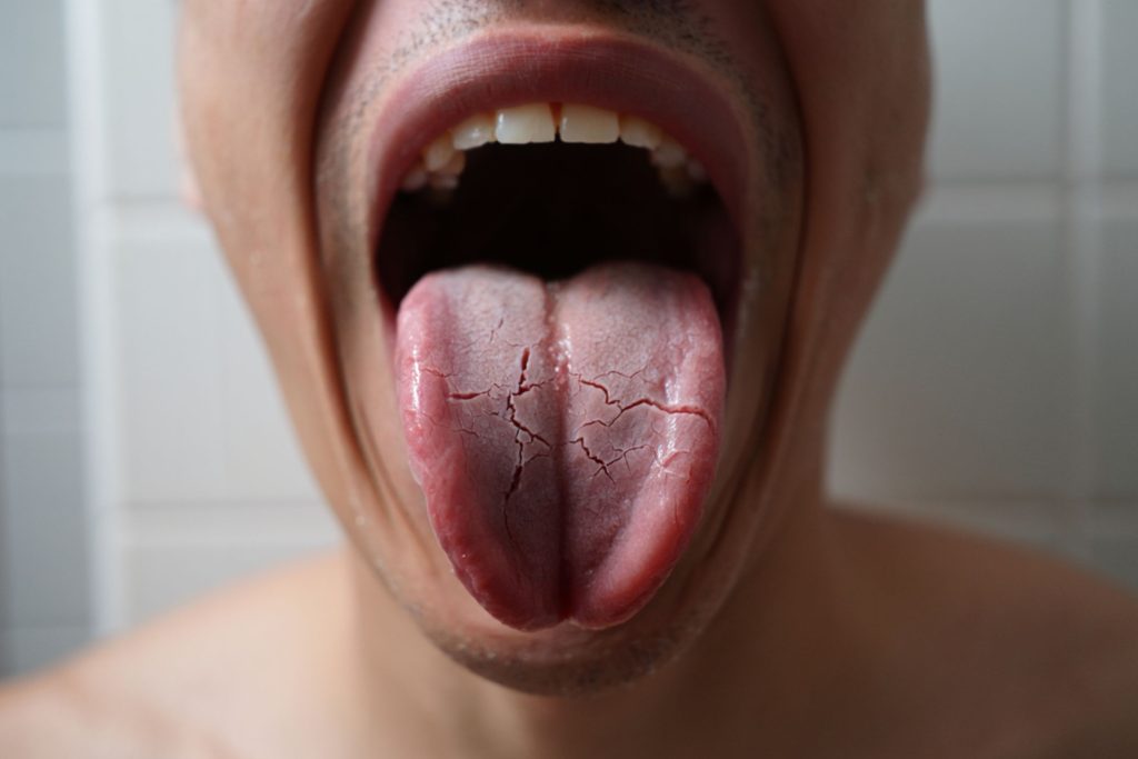 Photo d'une langue fissurée